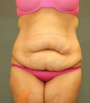 ABDOMINOPLASTY WITH LIPOSUCTION : Case 83 Before